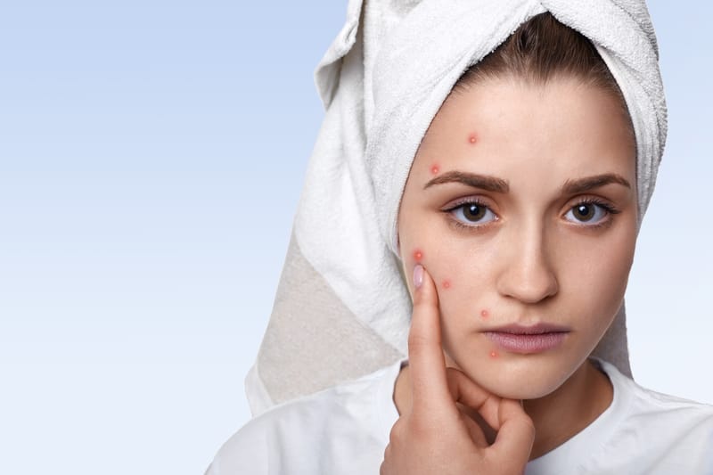 Do Pimple Patches Work on Unpopped Pimples?